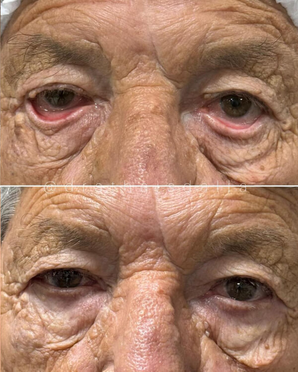 Correção de ectrópio palpebral