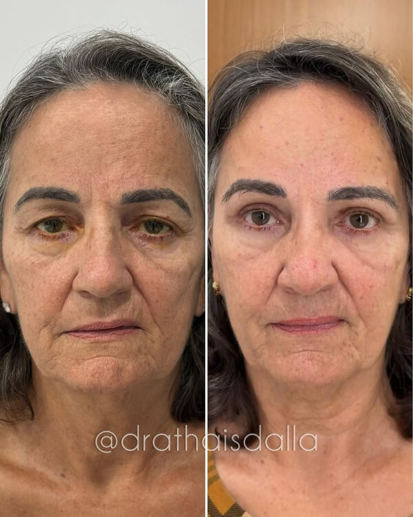 Blefaroplastia Superior